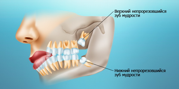Удаление зубов и синдром сухой лунки