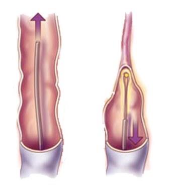 Лечение варикоза вен на ногах лазером в одинцово цена thumbnail