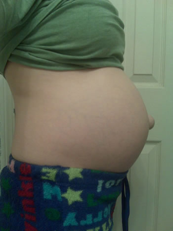 Фото пупочной грыжи у беременных